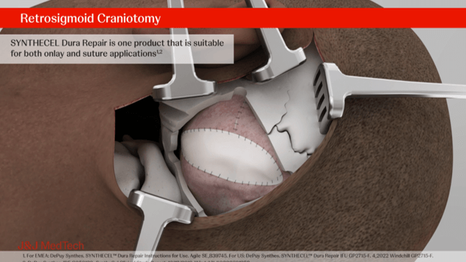 Retrosigmoid Craniotomy