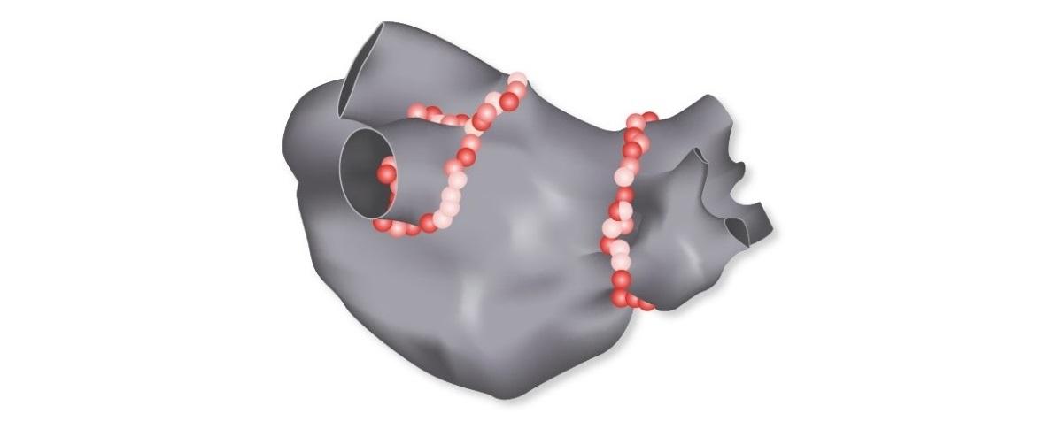 radiofrequency ablation success heart