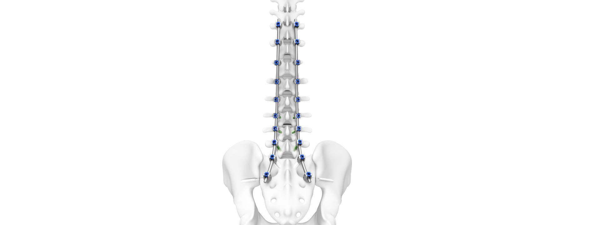 Illustrated example of TriALTIS™ Spine System attached to a human spine.