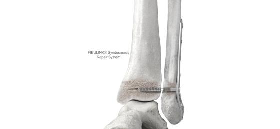 fibulink syndesmosis repair system