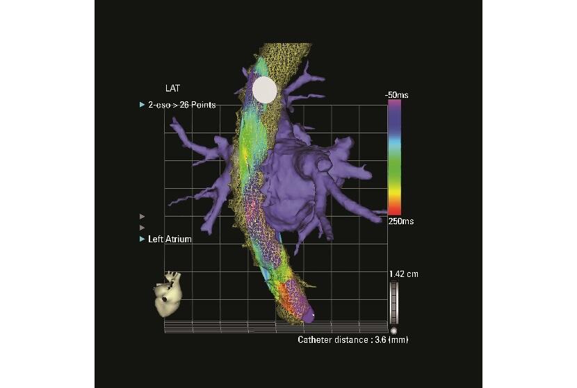 ESOPHASTAR™ Catheter
