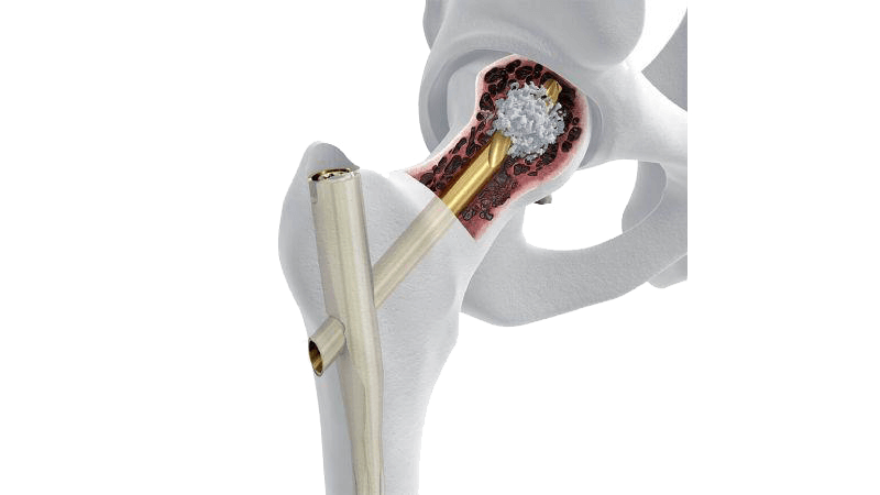 TFN-ADVANCED™ System seen inside of hip