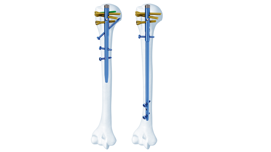 MultiLoc Humeral Nailing System seen inside of bone