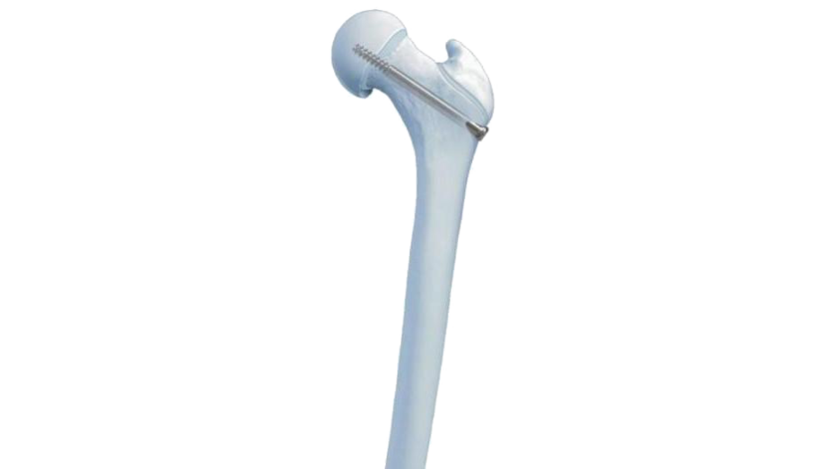 Slipped Capital Femoral Epiphysis Screw shown fixated in bone