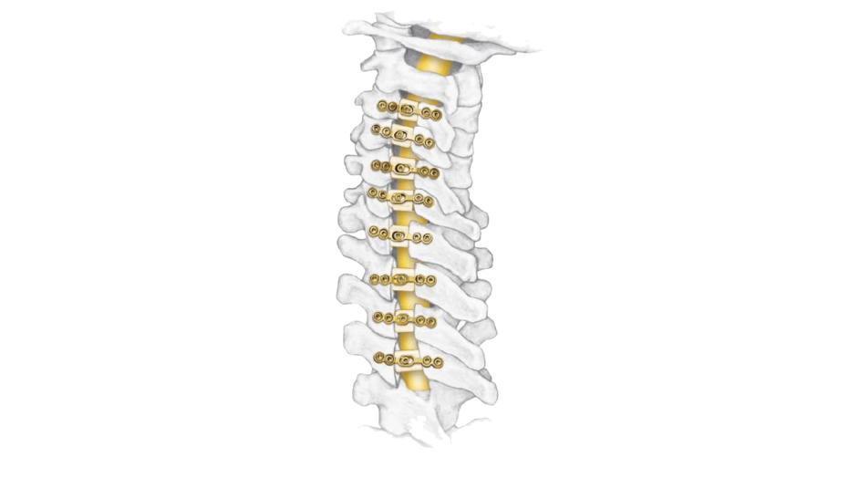 ARCH Fixation System 