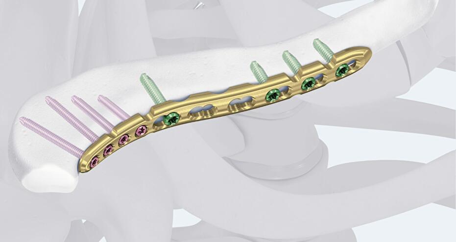 VA LCP Anterior Clavicle Plate in the bone
