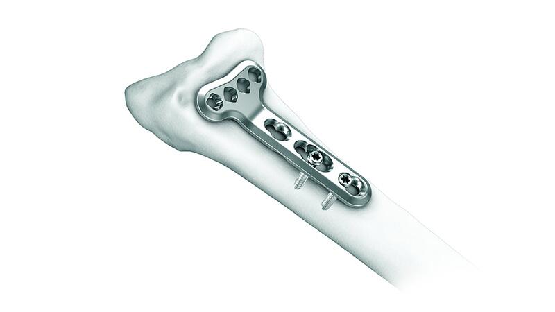 2.4 mm Variable Angle LCP Volar Extra-Articular Distal Radius System in Bone