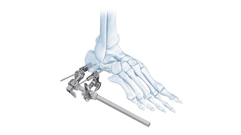 Orthopaedic Foot Systems being used together in bones of human foot