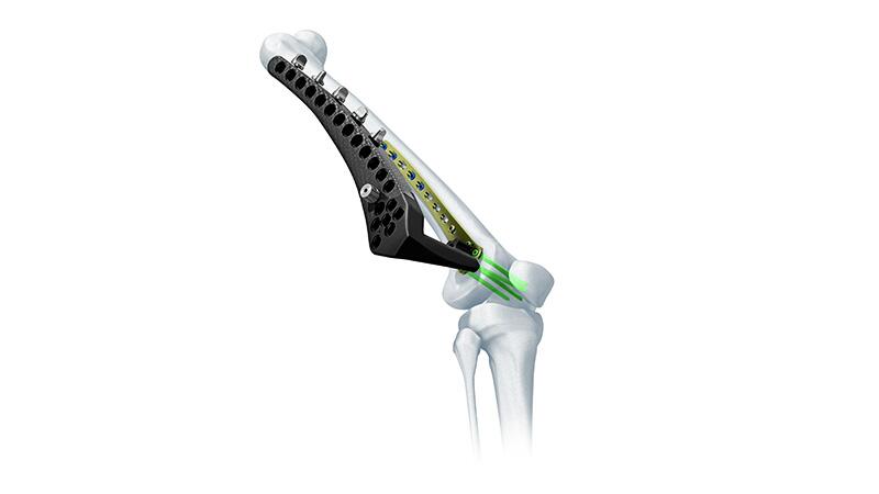 LCP Distal Femur Plate on bone with LISS Instrumentation