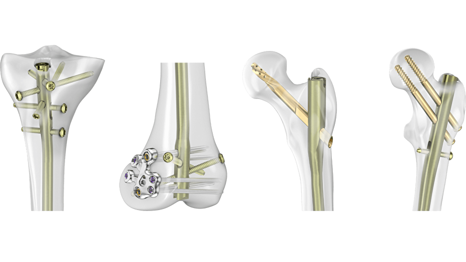 Bones with implants 