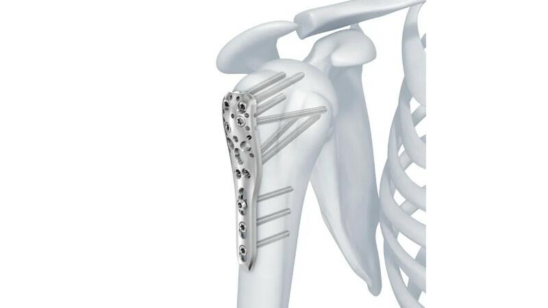 LCP™ Proximal Humerus Plate shown in bone