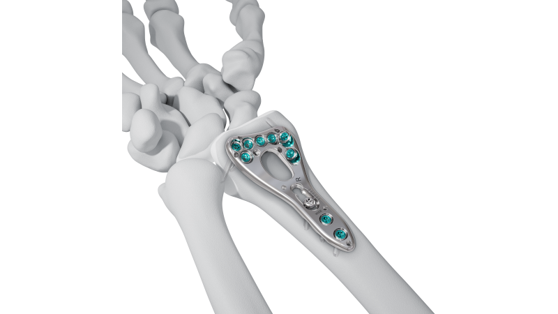 VOLT Distal Radius Two-Column Plate on bone 